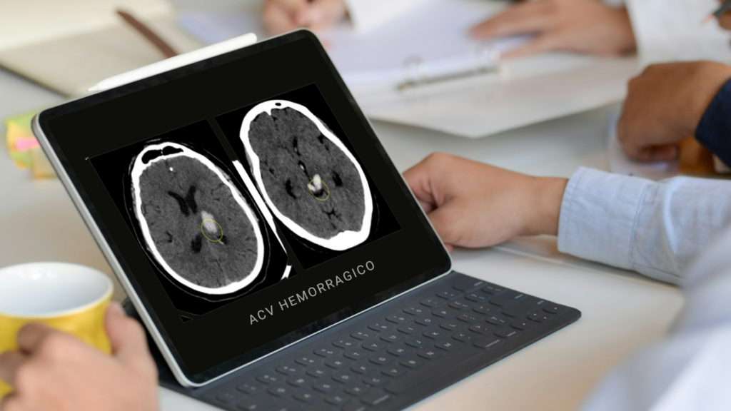 ACV hemorragico WEB